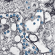 SARS-CoV-2 particles in a human patient, seen in blue.